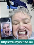 Эстетическая реставрация зубов - пример работы наших врачей